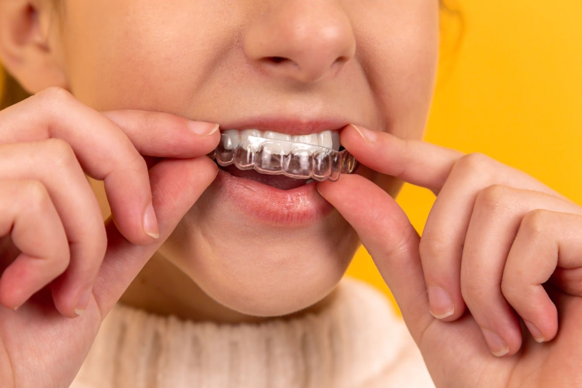 Close-up of a patient with a healthy smile fitting a clear aligner